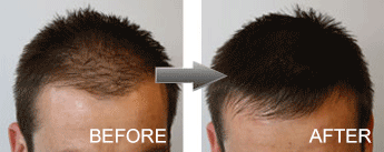 hair-fibres-male-before-and-after_grande.png