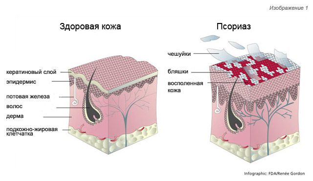 Питание при псориазе.